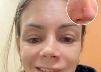 Artsen slaan alarm: dit gebeurt er als je een puistje uitknijpt in de ‘dodelijke driehoek’