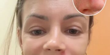 Artsen slaan alarm: dit gebeurt er als je een puistje uitknijpt in de ‘dodelijke driehoek’