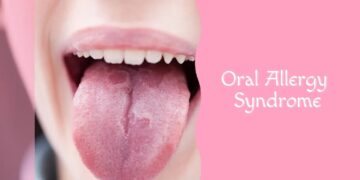 Steeds meer mensen krijgen klachten na fruit of noten: dit moet je weten over het Oraal Allergie Syndroom