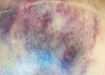 Slik jij bloedverdunners? Weet dit over de bijwerkingen