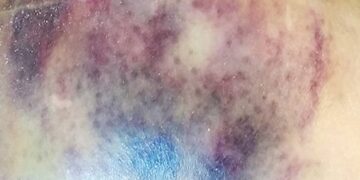 Slik jij bloedverdunners? Weet dit over de bijwerkingen