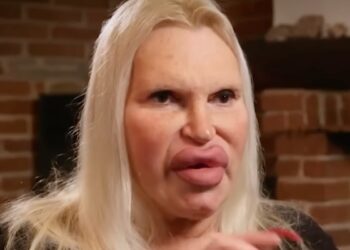 Na ruim 150 operaties voelt Fulvia zich eindelijk af