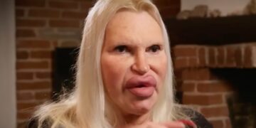 Na ruim 150 operaties voelt Fulvia zich eindelijk af