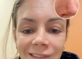 Wat begint met een puistje kan ernstig misgaan: artsen waarschuwen dringend