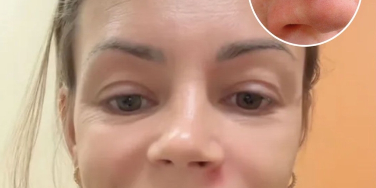 Wat begint met een puistje kan ernstig misgaan: artsen waarschuwen dringend