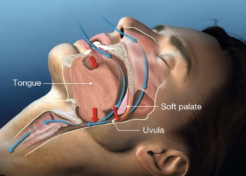 Zo herken je slaapapneu direct: veel mensen hebben het zonder het te weten….