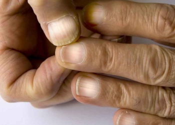 Dit is wat je handen en nagels onthullen over je lever: let op deze 4 vroege tekenen