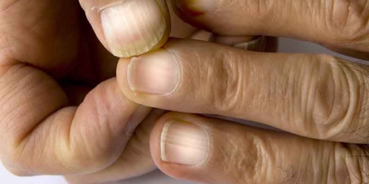 Dit is wat je handen en nagels onthullen over je lever: let op deze 4 vroege tekenen