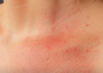 Huiduitslag door zweten? Zo herken je warmte-uitslag en zweetbrand