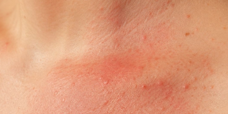 Huiduitslag door zweten? Zo herken je warmte-uitslag en zweetbrand