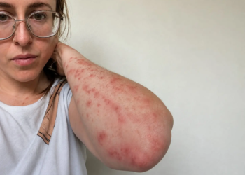 HEFTIG! Vrouw (31) doet schokkende ontdekking na hotelnacht: ‘Meer dan 100 keer gebeten’