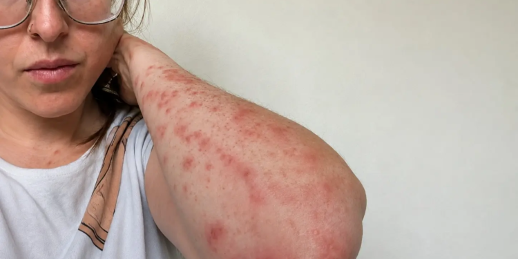 HEFTIG! Vrouw (31) doet schokkende ontdekking na hotelnacht: ‘Meer dan 100 keer gebeten’